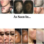 NoviaGlow Derma Roller